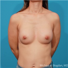Breast Augmentation After Photo by Michael Bogdan, MD, MBA, FACS; Grapevine, TX - Case 47223