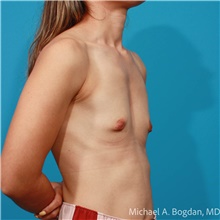 Breast Augmentation Before Photo by Michael Bogdan, MD, MBA, FACS; Grapevine, TX - Case 47223
