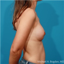 Breast Augmentation After Photo by Michael Bogdan, MD, MBA, FACS; Grapevine, TX - Case 47223