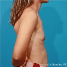 Breast Augmentation Before Photo by Michael Bogdan, MD, MBA, FACS; Grapevine, TX - Case 47223