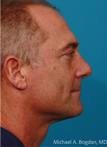 Eyelid Surgery After Photo by Michael Bogdan, MD, MBA, FACS; Grapevine, TX - Case 47229