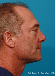 Eyelid Surgery Before Photo by Michael Bogdan, MD, MBA, FACS; Grapevine, TX - Case 47229