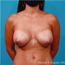 Breast Augmentation After Photo by Michael Bogdan, MD, MBA, FACS; Grapevine, TX - Case 47233