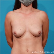 Breast Augmentation Before Photo by Michael Bogdan, MD, MBA, FACS; Grapevine, TX - Case 47233