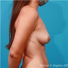 Breast Augmentation Before Photo by Michael Bogdan, MD, MBA, FACS; Grapevine, TX - Case 47233