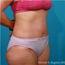 Tummy Tuck After Photo by Michael Bogdan, MD, MBA, FACS; Grapevine, TX - Case 47239