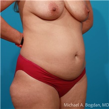 Tummy Tuck Before Photo by Michael Bogdan, MD, MBA, FACS; Grapevine, TX - Case 47239