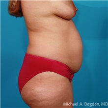 Tummy Tuck Before Photo by Michael Bogdan, MD, MBA, FACS; Grapevine, TX - Case 47239