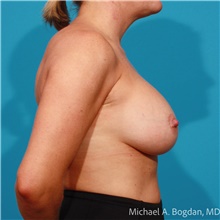 Breast Augmentation After Photo by Michael Bogdan, MD, MBA, FACS; Grapevine, TX - Case 47436