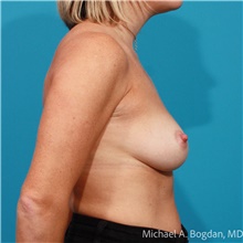 Breast Augmentation Before Photo by Michael Bogdan, MD, MBA, FACS; Grapevine, TX - Case 47436
