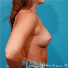 Breast Augmentation After Photo by Michael Bogdan, MD, MBA, FACS; Grapevine, TX - Case 47438