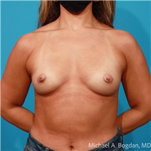Breast Augmentation Before Photo by Michael Bogdan, MD, MBA, FACS; Grapevine, TX - Case 47438