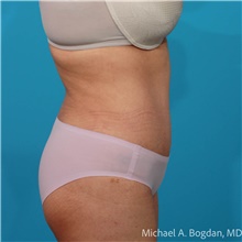 Tummy Tuck After Photo by Michael Bogdan, MD, MBA, FACS; Grapevine, TX - Case 47439