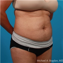 Tummy Tuck Before Photo by Michael Bogdan, MD, MBA, FACS; Grapevine, TX - Case 47439