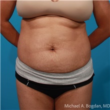 Tummy Tuck Before Photo by Michael Bogdan, MD, MBA, FACS; Grapevine, TX - Case 47439