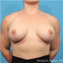 Breast Augmentation After Photo by Michael Bogdan, MD, MBA, FACS; Grapevine, TX - Case 48028