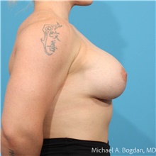 Breast Augmentation After Photo by Michael Bogdan, MD, MBA, FACS; Grapevine, TX - Case 48028