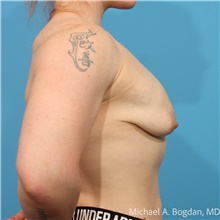 Breast Augmentation Before Photo by Michael Bogdan, MD, MBA, FACS; Grapevine, TX - Case 48028
