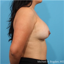 Breast Augmentation After Photo by Michael Bogdan, MD, MBA, FACS; Grapevine, TX - Case 48029