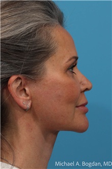 Facelift After Photo by Michael Bogdan, MD, MBA, FACS; Grapevine, TX - Case 48030