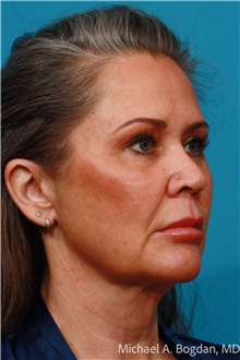 Facelift Before Photo by Michael Bogdan, MD, MBA, FACS; Grapevine, TX - Case 48030