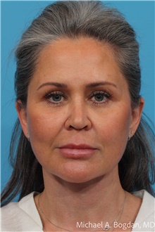 Facelift After Photo by Michael Bogdan, MD, MBA, FACS; Grapevine, TX - Case 48030