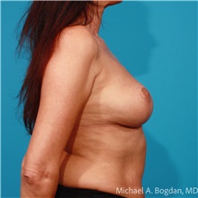 Breast Augmentation Before Photo by Michael Bogdan, MD, MBA, FACS; Grapevine, TX - Case 48031