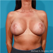 Breast Augmentation After Photo by Michael Bogdan, MD, MBA, FACS; Grapevine, TX - Case 48031