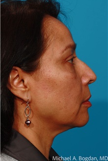 Eyelid Surgery After Photo by Michael Bogdan, MD, MBA, FACS; Grapevine, TX - Case 48032