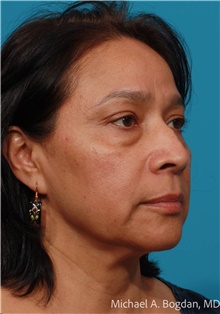 Eyelid Surgery Before Photo by Michael Bogdan, MD, MBA, FACS; Grapevine, TX - Case 48032
