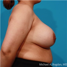 Breast Implant Removal Before Photo by Michael Bogdan, MD, MBA, FACS; Grapevine, TX - Case 48041