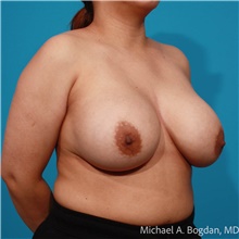 Breast Implant Removal Before Photo by Michael Bogdan, MD, MBA, FACS; Grapevine, TX - Case 48041