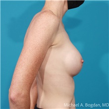 Breast Augmentation After Photo by Michael Bogdan, MD, MBA, FACS; Grapevine, TX - Case 48042
