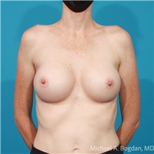 Breast Augmentation After Photo by Michael Bogdan, MD, MBA, FACS; Grapevine, TX - Case 48042