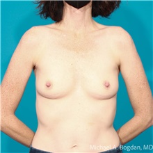 Breast Augmentation Before Photo by Michael Bogdan, MD, MBA, FACS; Grapevine, TX - Case 48042