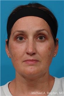 Eyelid Surgery After Photo by Michael Bogdan, MD, MBA, FACS; Grapevine, TX - Case 48043