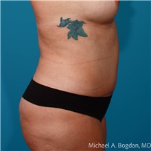 Tummy Tuck After Photo by Michael Bogdan, MD, MBA, FACS; Grapevine, TX - Case 48045