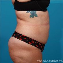 Tummy Tuck Before Photo by Michael Bogdan, MD, MBA, FACS; Grapevine, TX - Case 48045