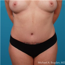 Tummy Tuck After Photo by Michael Bogdan, MD, MBA, FACS; Grapevine, TX - Case 48045