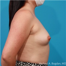 Breast Augmentation Before Photo by Michael Bogdan, MD, MBA, FACS; Grapevine, TX - Case 48046