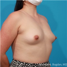 Breast Augmentation Before Photo by Michael Bogdan, MD, MBA, FACS; Grapevine, TX - Case 48046