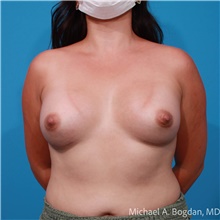 Breast Augmentation After Photo by Michael Bogdan, MD, MBA, FACS; Grapevine, TX - Case 48046