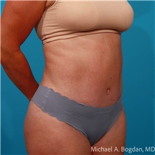 Tummy Tuck After Photo by Michael Bogdan, MD, MBA, FACS; Grapevine, TX - Case 48047