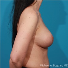 Breast Augmentation After Photo by Michael Bogdan, MD, MBA, FACS; Grapevine, TX - Case 48067