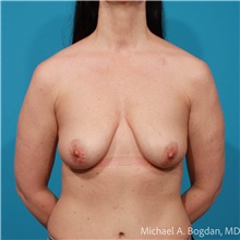 Breast Augmentation Before Photo by Michael Bogdan, MD, MBA, FACS; Grapevine, TX - Case 48067