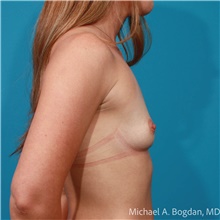 Breast Augmentation Before Photo by Michael Bogdan, MD, MBA, FACS; Grapevine, TX - Case 48069