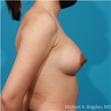 Breast Augmentation After Photo by Michael Bogdan, MD, MBA, FACS; Grapevine, TX - Case 48071