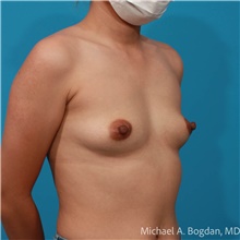Breast Augmentation Before Photo by Michael Bogdan, MD, MBA, FACS; Grapevine, TX - Case 48071
