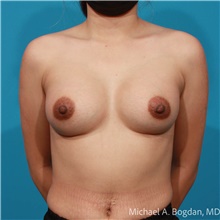 Breast Augmentation After Photo by Michael Bogdan, MD, MBA, FACS; Grapevine, TX - Case 48071