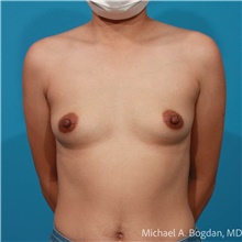 Breast Augmentation Before Photo by Michael Bogdan, MD, MBA, FACS; Grapevine, TX - Case 48071